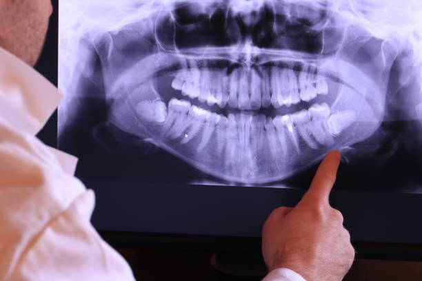 Best Emergency Wisdom Teeth Removal in Clinton, TN