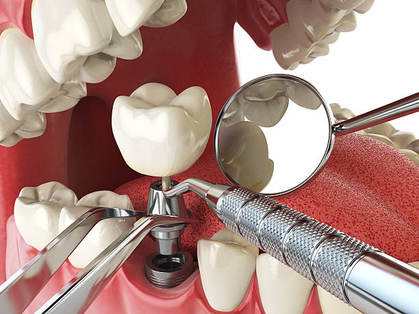 Best Emergency Root Canal Treatment in Clinton, TN